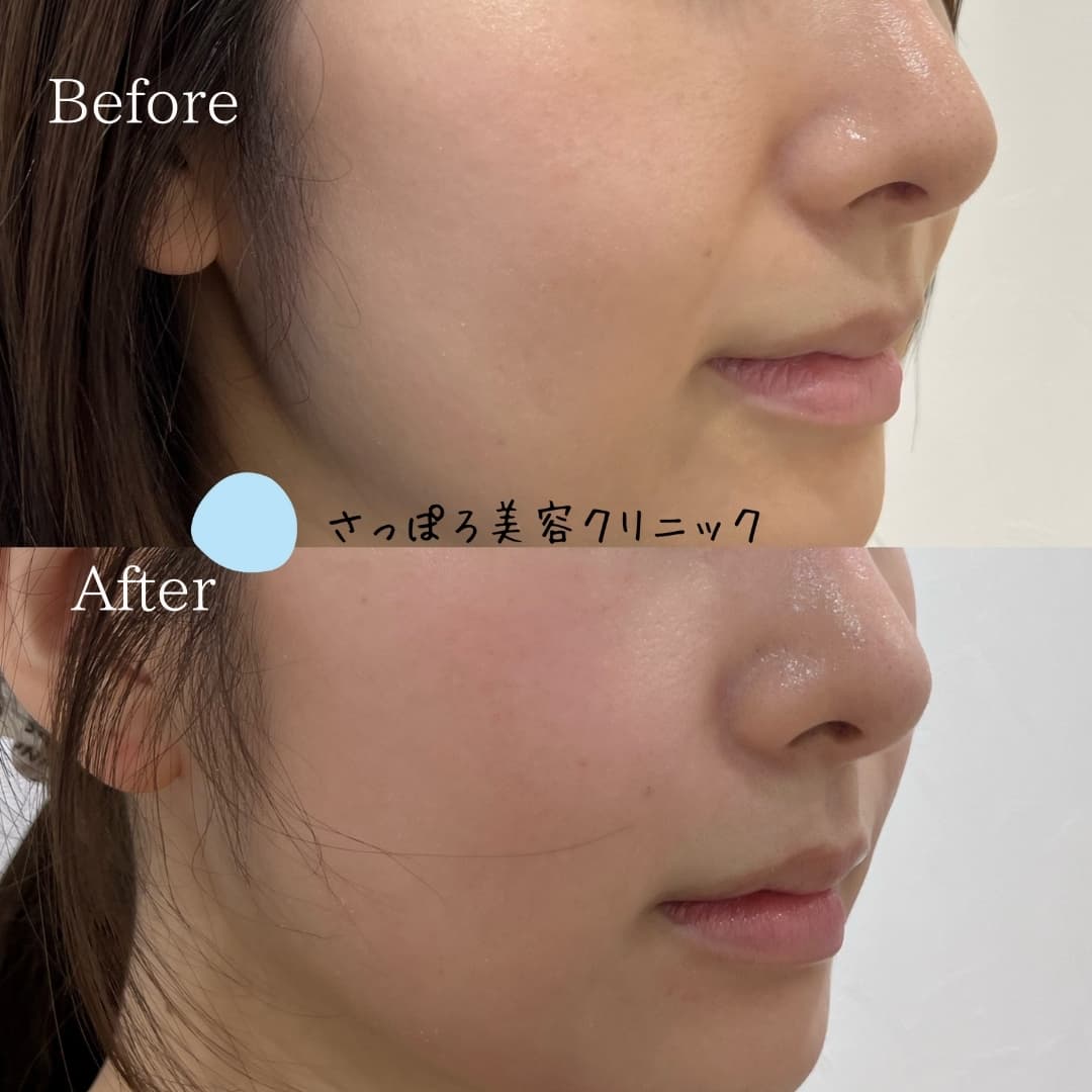 ヒアルロン酸注入