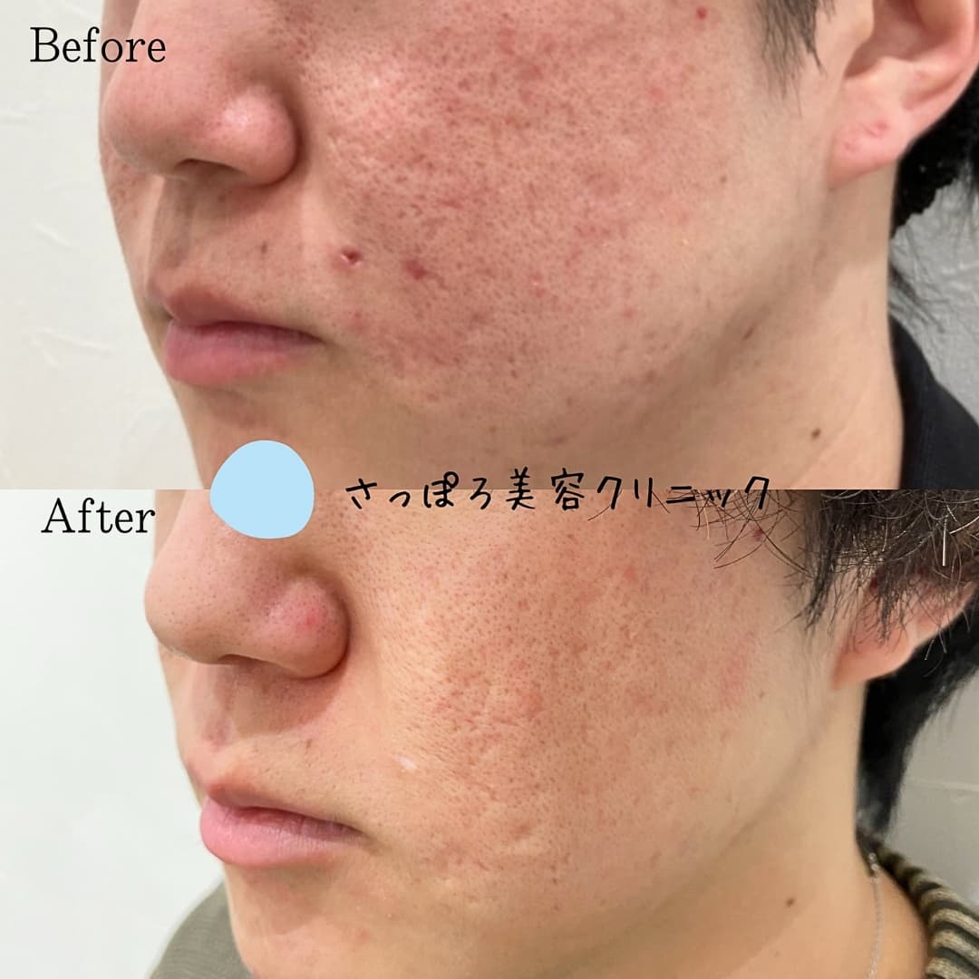 トライフィルプロ (マニュアルインジェクション)