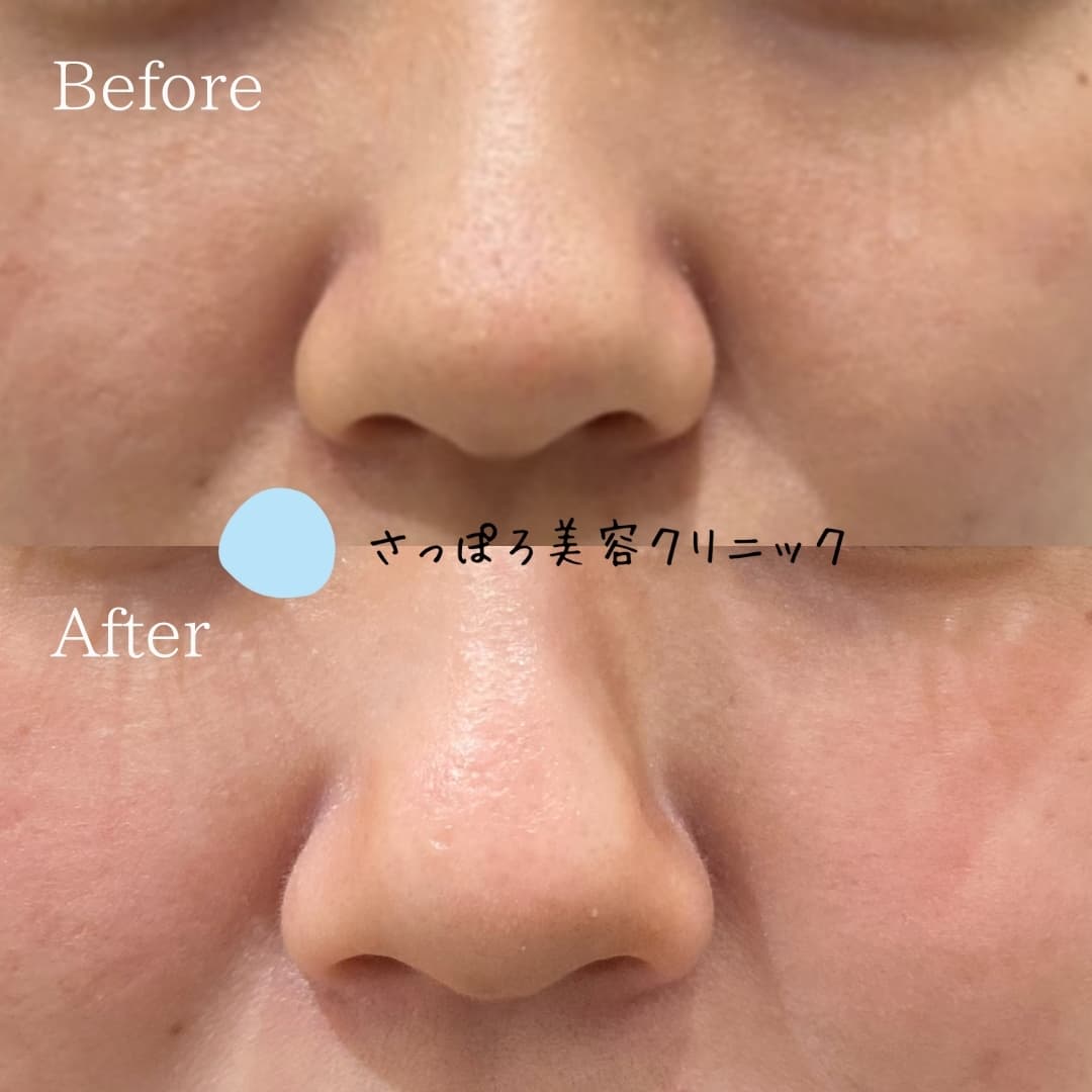 脂肪溶解注射 4回