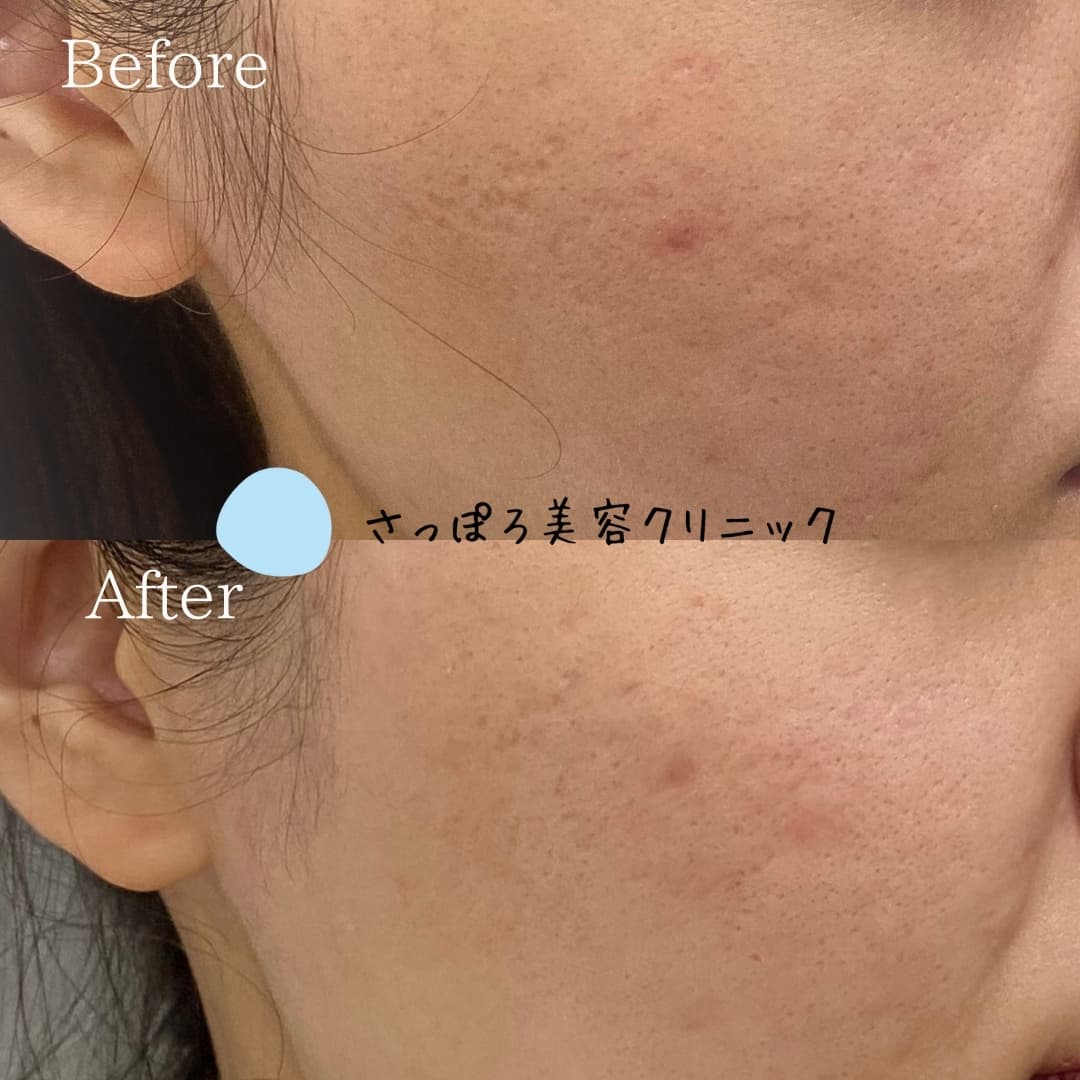 トライフィルプロ (マニュアルインジェクション)