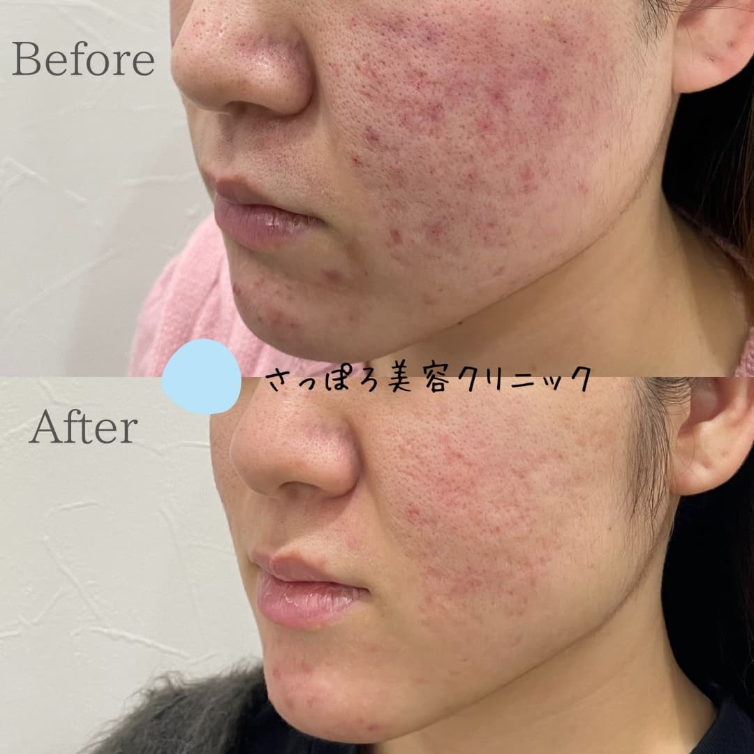 手打ち注射(肌育注射) 4回