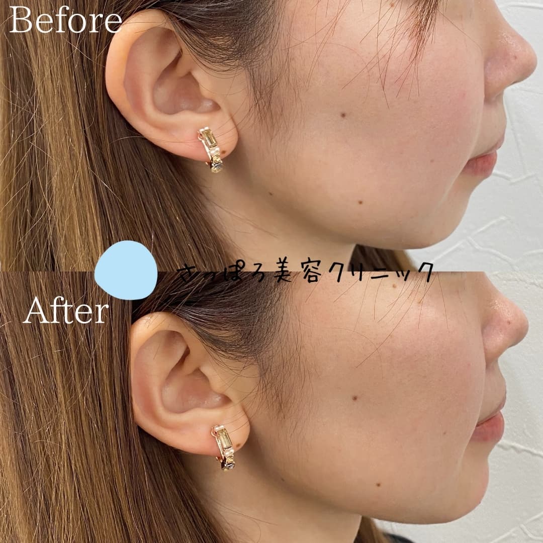 ヒアルロン酸注入