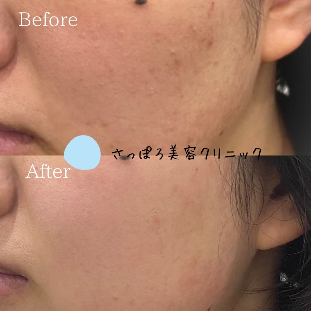 ダーマペン(ニキビセット) ジャンマリーニ デュアリティーフェイスクリーム併用